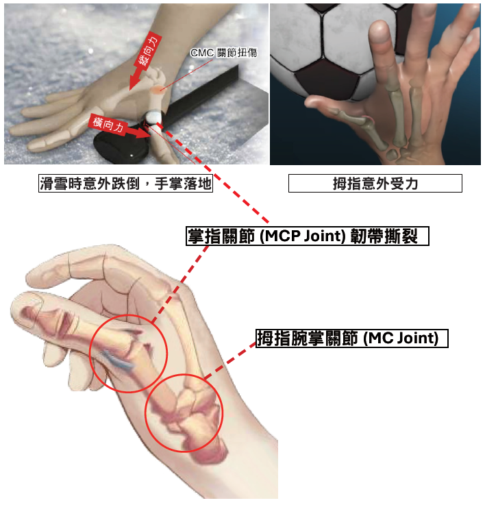 Thumb sprain mechanism